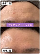 プリュネル(Prunelle)/プラズマシャワー