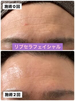 プリュネル(Prunelle)/プラズマシャワー