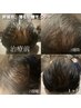 【幹細胞を使った育毛促進メニュー★60分】￥9500円→￥7800円