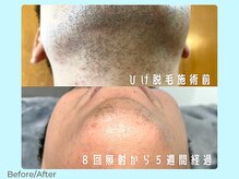 ワンズライフ(ONE‘S LIFE)/Before/After【ひげ8回目】