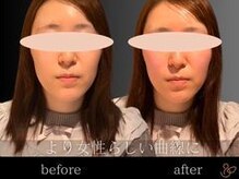 チョコバリ 渋谷店(chocobari)/小顔×リフトアップ(美容鍼)20代