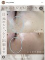 リル バイ アンドアール(Rire by and.R)&nbsp;レーザーと違い夏場でもできるシミケアメニューとなります！