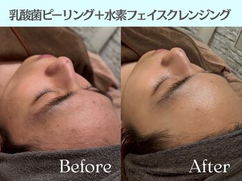 ロイボーテ(ROI Beaute)/毛穴すっきり&なめらか美肌