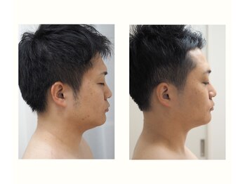 ユニクリア(Uni clear)/二重あご・頬・首 レモンボトル