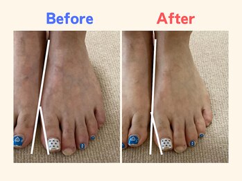 ピース/足指の曲がりが気になる40代女性