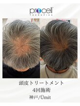 ユミト(Umit)/プロセルスカルプ