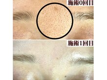 エクレ 下北沢店(ecle)/毛穴・肌質改善もエクレ下北沢で