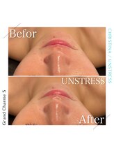 グランドシャルムエス(Grand Charme S)/南森町/肌荒れ/ピーリング