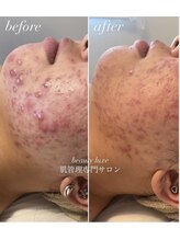 ビューティリュクス(beauty luxe)/徹底肌荒れケアはお任せ下さい