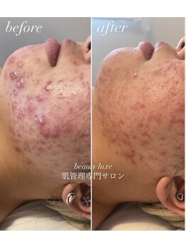 ビューティリュクス(beauty luxe)/徹底肌荒れケアはお任せ下さい