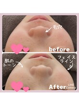 煌/ケースタイル(K-style)/ハーブピーリング