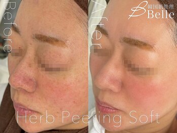 ベル 札幌(Belle)/ハーブピーリング｜ニキビケア