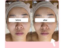 豊橋初上陸"レッドショット"フェイスラインのみ！1回でこの変化