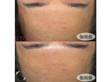 ストーリー(STORY)/眉毛と艶肌ワックス専門店