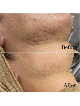 リブ(Lib)/メンズのお肌悩みも解決♪