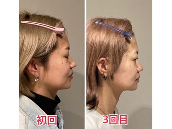 小顔22 ボルティ 赤坂支店(Bolty)/小顔シンメトリー矯正＆全身矯正