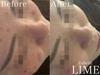 ライム 天神(LIME)/before&after　トーンアップ