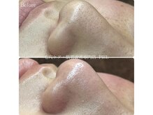 ピエル 北千住店(PIEL)/毛穴ケアはPIEL