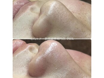 ピエル 北千住店(PIEL)/毛穴ケアはPIEL