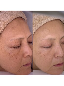 ナヴィータ アオバダイ(Navita AOBADAI)/エンビロン/2ヶ月集中コース