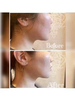 カンコルギセラピー 西新宿店 フレッシュタイム(KAN)/リフトアップ！