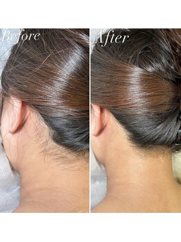 インベスト(INVEST)/うなじ脱毛