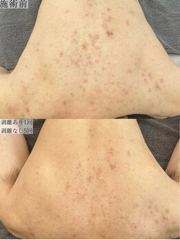 ヴェルシック(Belchic)/背中にも2種類の国産ハーブ