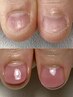 【女性/深爪矯正】1回お試し/道内初の深爪矯正リプロ/即日見た目改善¥21000→