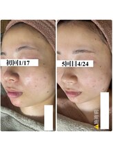 アルムダアクア 天王寺店(Aleumda AQUA)/ハーブピーリング/大阪/天王寺