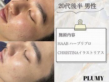 プリューミー(PLUMY)/HAABREPRO Before/After