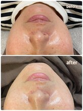 ニコリ(Nicori)/ハーブピーリング