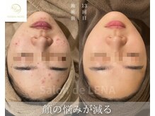 サロン ド レナ(Salon de LENA)/ハーブピーリング サロンドレナ