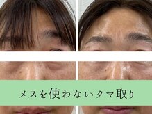 ソルニスデュオ(Solnis.-duo-)/小顔/酵素浴/ハイパーナイフEX2