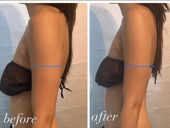 ビノスビューティー(vinos.beauty)/韓国から上陸！脂肪分解