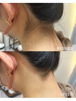 エース(ACE.)/うなじ脱毛で清潔感アップ♪