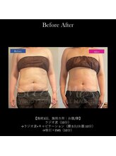 ドルチェビューティーサロン 戸塚安行店(Dolce Beauty Salon)/痩身（お腹・腰）_施術3回