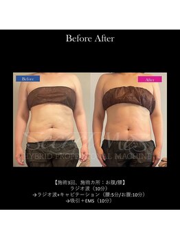 ドルチェビューティーサロン 戸塚安行店(Dolce Beauty Salon)/痩身（お腹・腰）_施術3回
