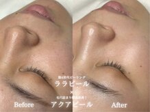 リル 和歌山市店(lilou)/ララ+アクアピールBefore after