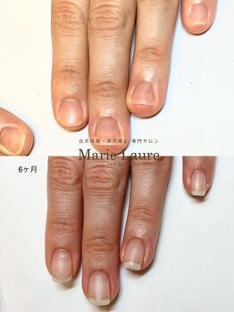 マリーロール 梅田店(Marie Laure)/自爪育成/深爪矯正/ネイルケア