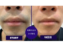 フェイシャル専門サロン サロン ド ウイッシュ/メンズひげ脱毛
