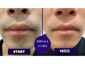 フェイシャル専門サロン サロン ド ウイッシュ/メンズひげ脱毛