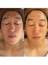 エステティックサロン やすらぎ心花(konoka)/結果重視プラズマフェイシャル