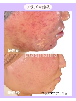 ホリホック/プラズマ症例