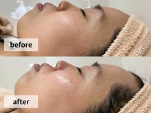 ウェイビーズ エステ(wavy's.esthetic)/【ビフォーアフター】毛穴ケア