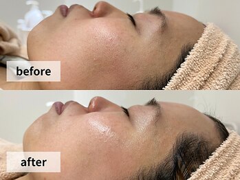 ウェイビーズ エステ(wavy's.esthetic)/【ビフォーアフター】毛穴ケア