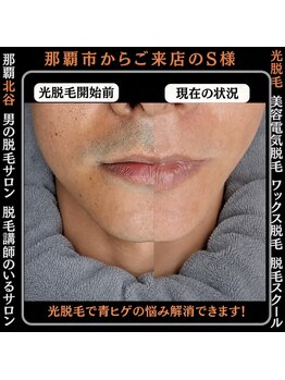ディースタイル 北谷店(Dstyle)/北谷メンズ脱毛ヒゲBefore after