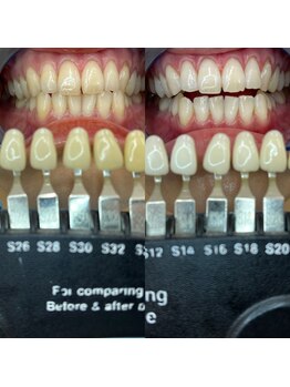 トウキョウスワーズ 池袋店(TOKYO SWRS)/#ホワイトニング #池袋 #渋谷