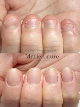 マリーロール 淀屋橋本店(Marie Laure)/自爪育成/深爪矯正/ネイルケア