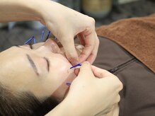 リベルタ鍼灸整骨院 新宿院(Liberta鍼灸整骨院)/美容メニューもございます！！