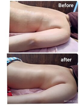 シャルマン(charmant)/痩身ラジオ波・キャビテーション